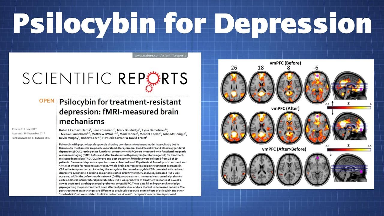 PsylocibinDepressione